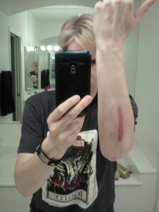My Scraped Up Arm - 35 Hours After the Fall