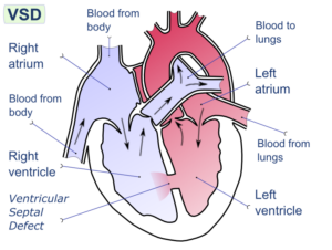 Ventricular Septal Defect (VSD) - Creative Commons Image from Wikipedia