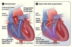 Atrial Septal Defect - Image from Wikipedia (Creative Commons Image)